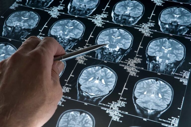 Una alianza global para combatir a las enfermedades neurodegenerativas